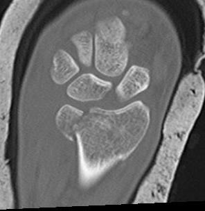 DRUJ Fracture CT